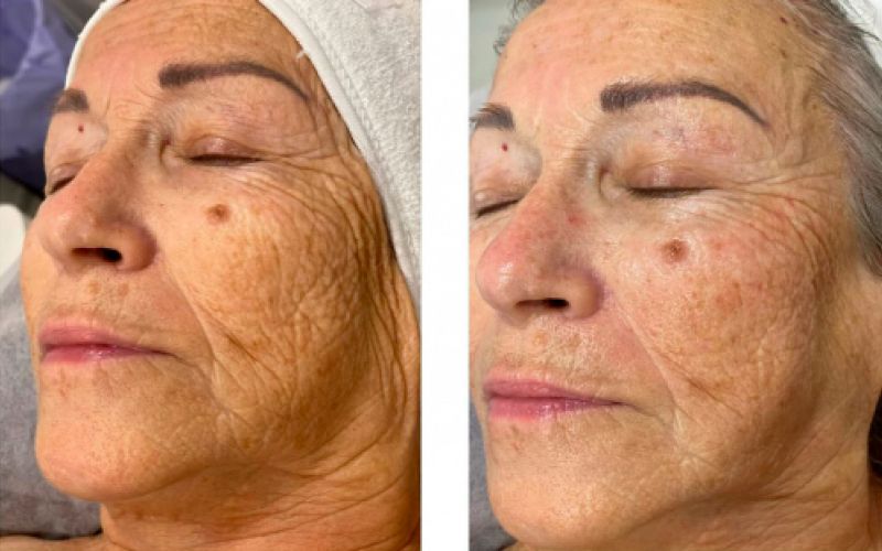 Imagen de antes y después de tratamiento facial en cara de mujer mayor