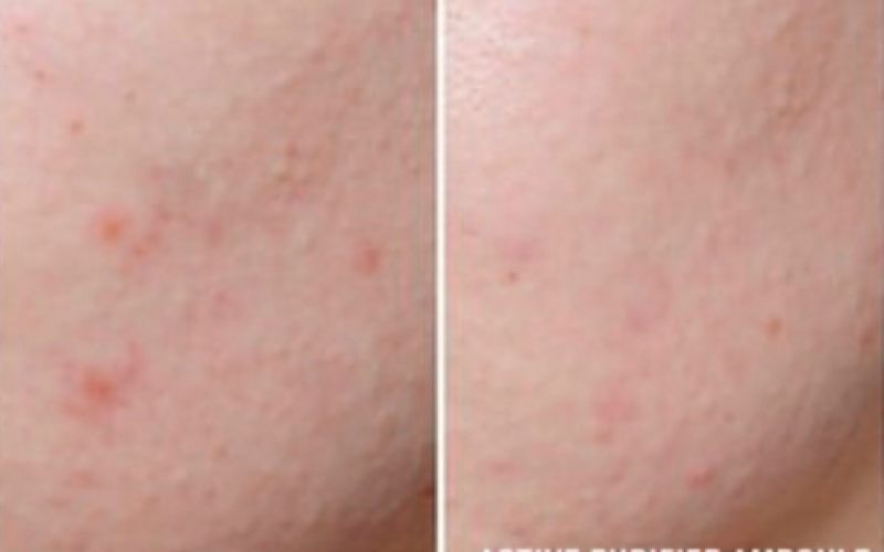 Imagen de antes y después de tratamiento facial en cara