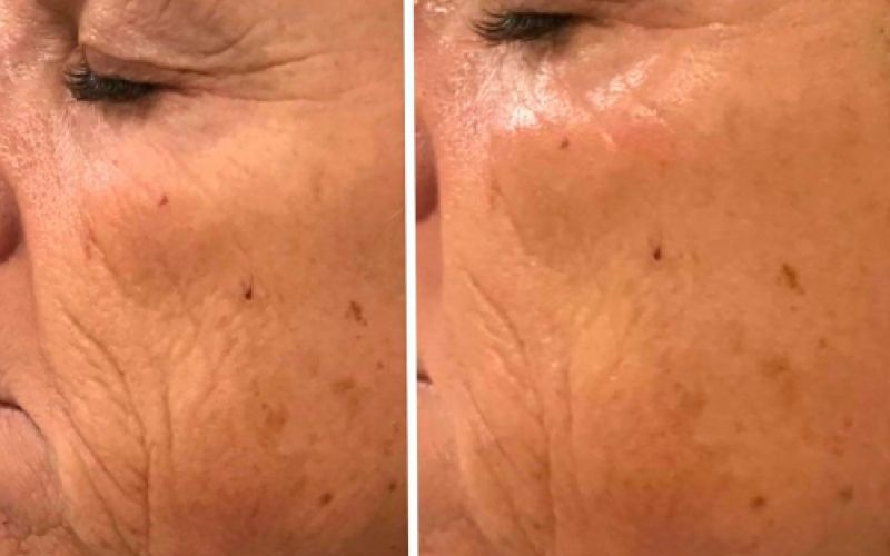 Imagen de antes y después de tratamiento facial en mujer adulta