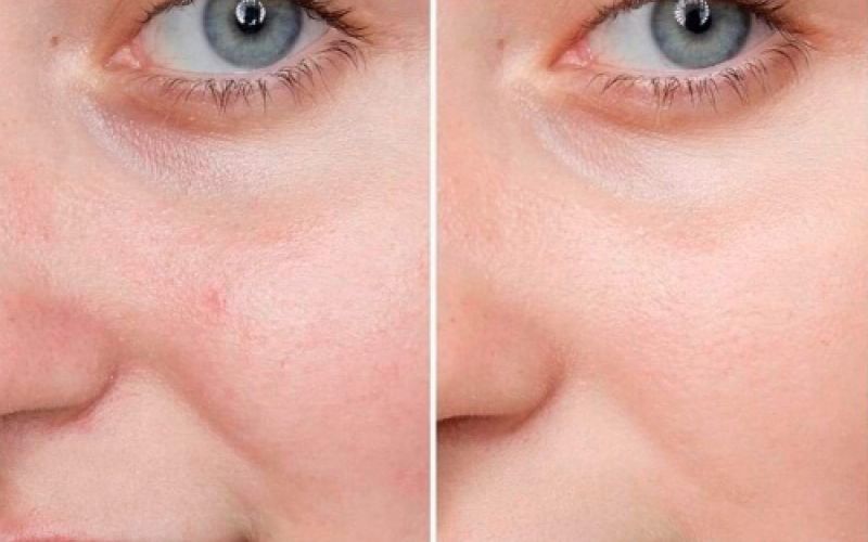 Imagen del antes y el después de tratamiento facial