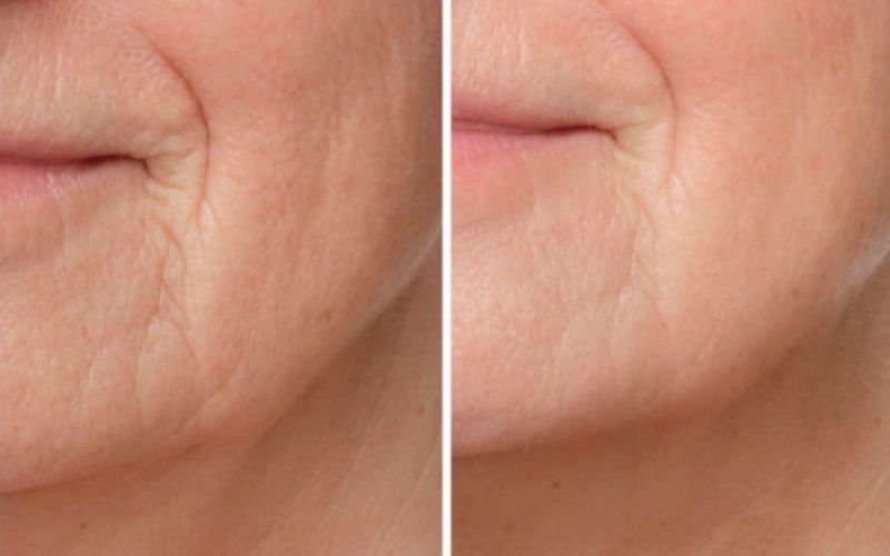 Imagen de antes y después de tratamiento facial en cara de mujer adulta