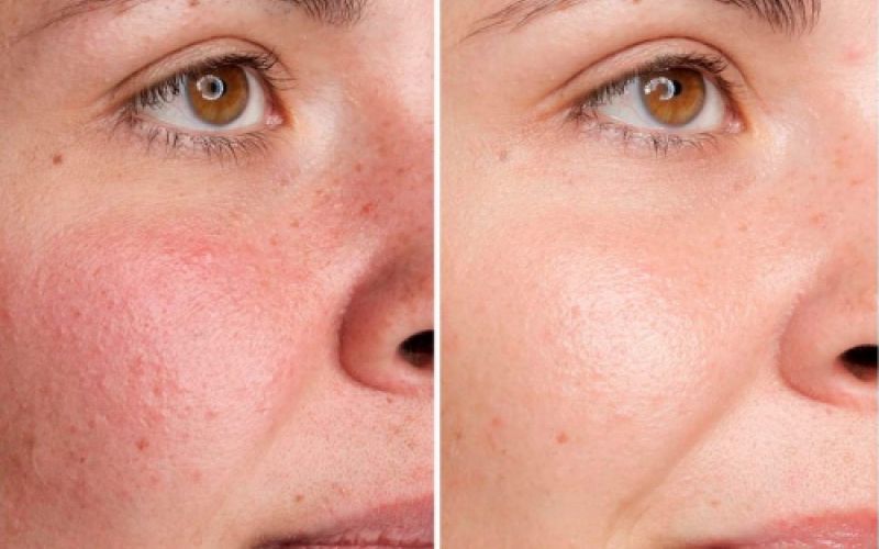 Imagen de antes y después de tratamiento facial