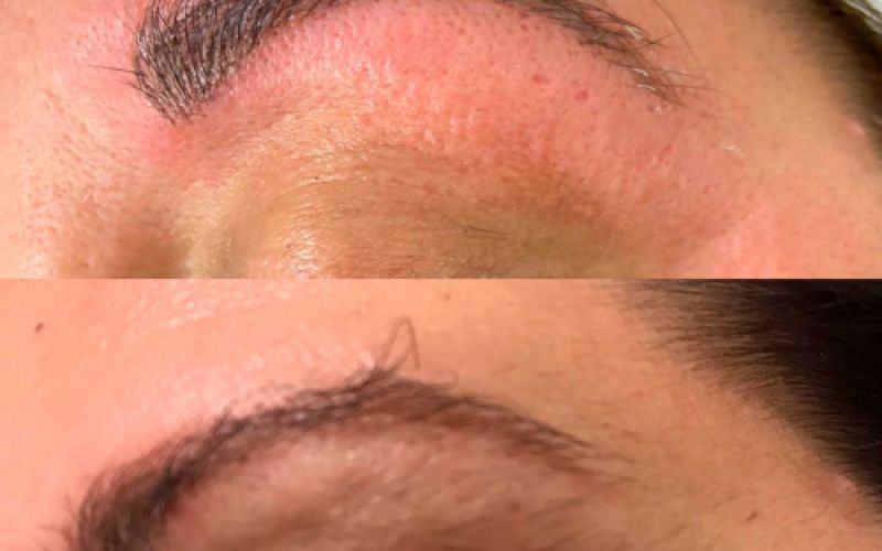 Imagen de antes y después de tratamiento de cejas